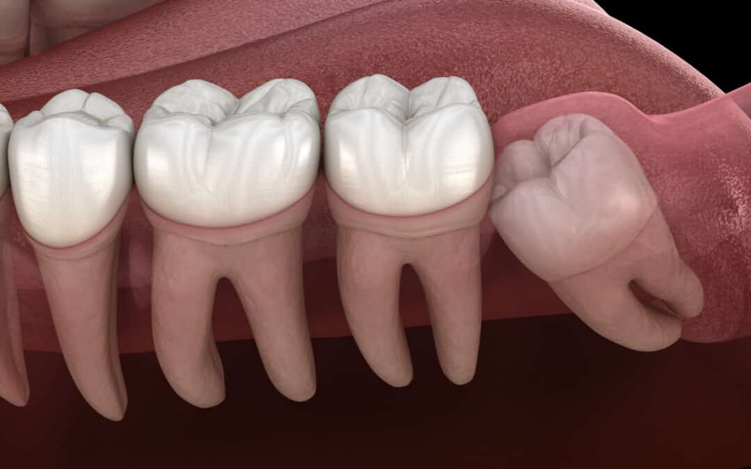 8 Signs You Need Your Wisdom Teeth Removed