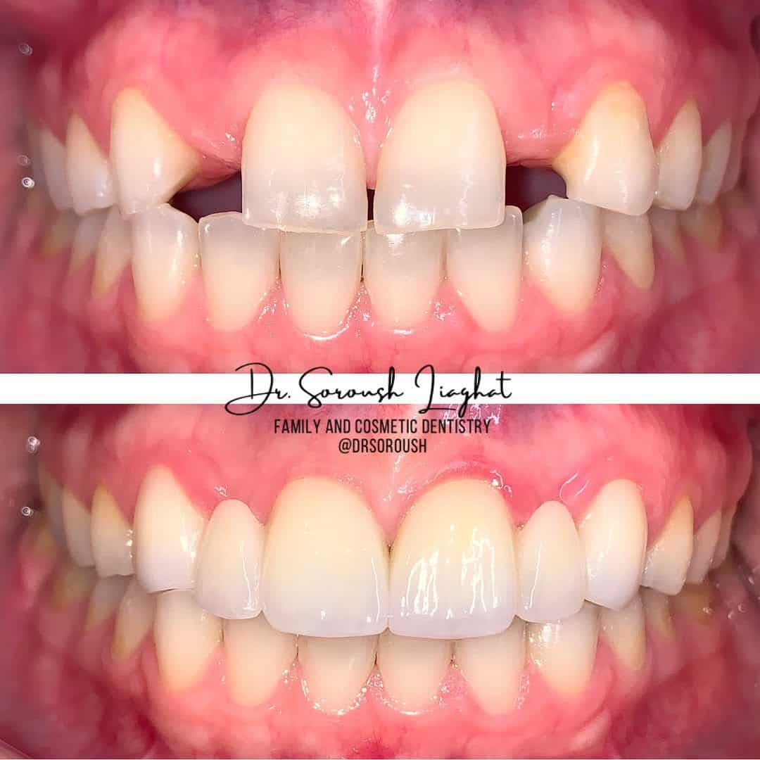 dentistry_thirty_two_smile_makeover_before_and_after