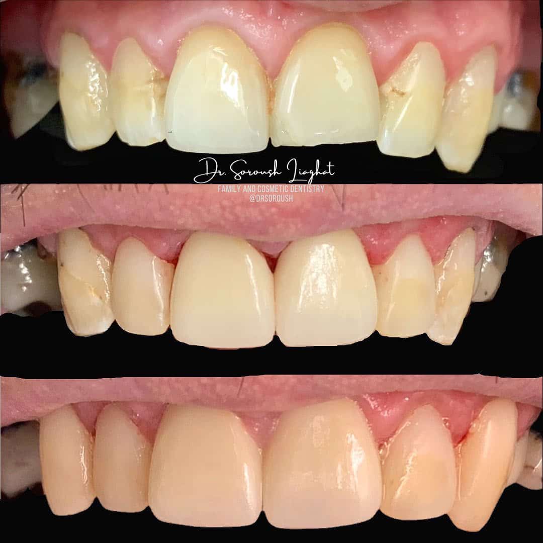 dentistry_thirty_two_smile_makeover_before_and_after_2