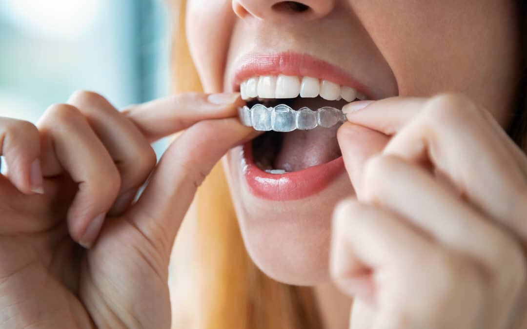 Invisalign Cleaning and Maintaining
