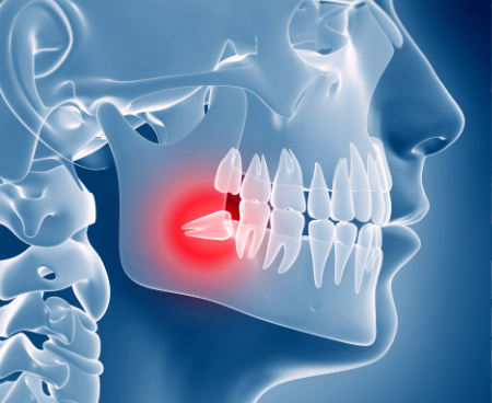 dentistry_thirty_two_wisdom_teet_extractions_wisdom_teeth_xray