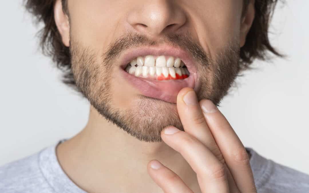 Six Ways To Prevent Receding Gums