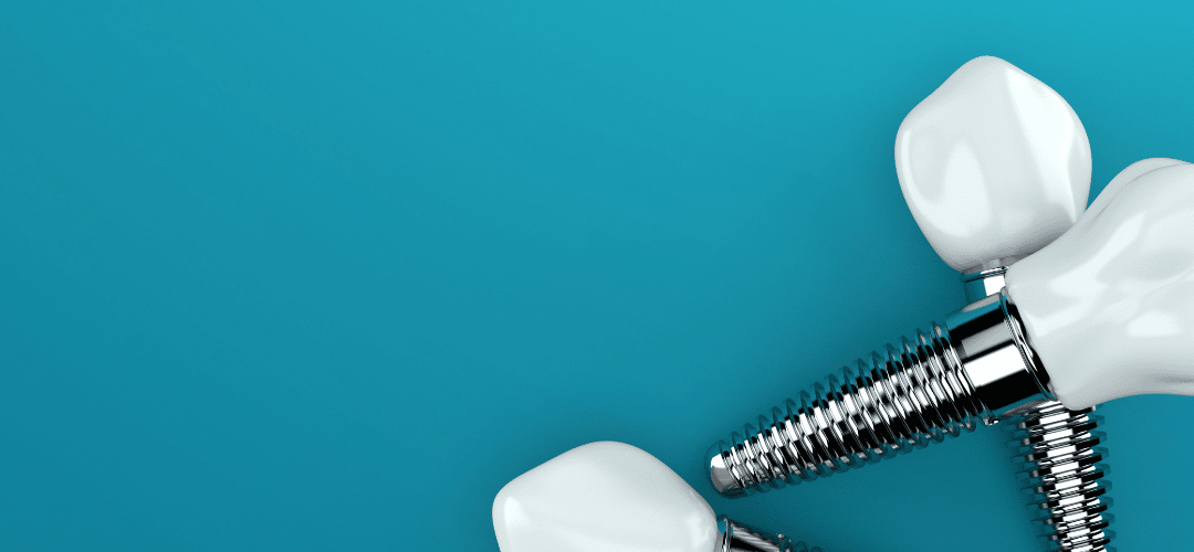 Need To Know Dental Implants