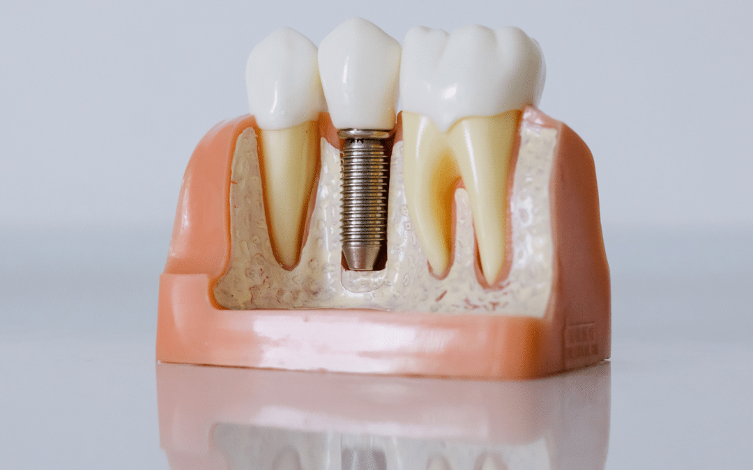 Need To Know Dental Implants