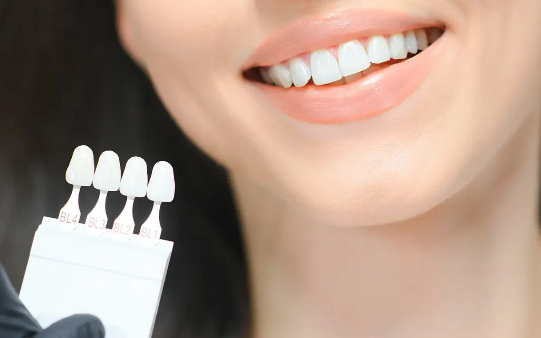 teeth whitening kit.