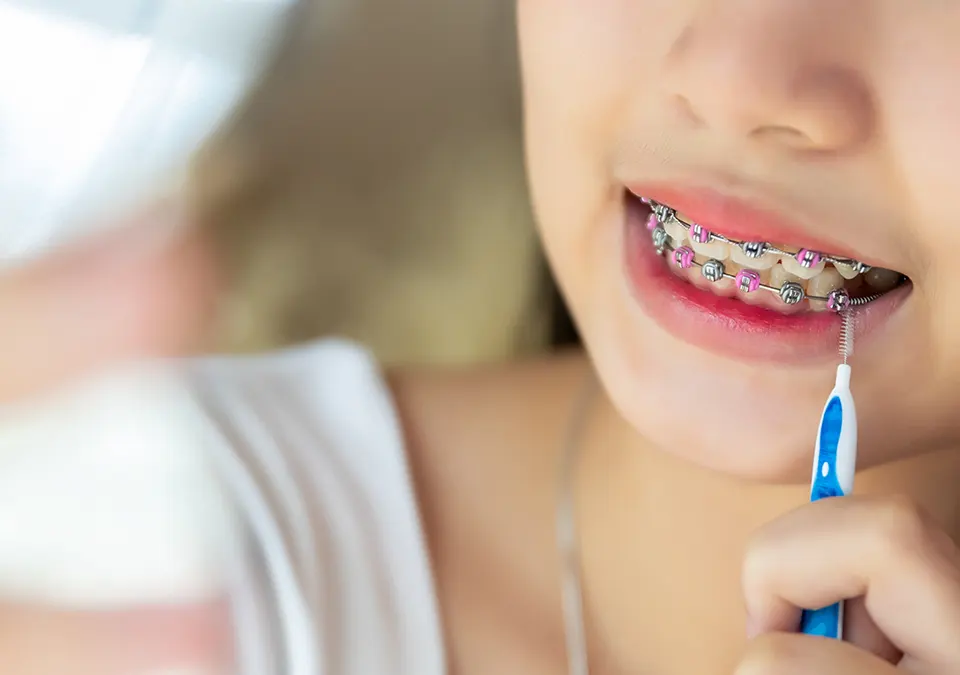 Having Trouble With Braces Teeth Cleaning? We Have Tips!